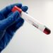 otthoni-STD-test_pic1